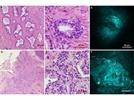 Use of Coherent Anti-Stokes Raman Scattering (CARS) to Meet the Challenges of Intraoperative Imaging