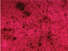 A Promise Kept: Stem Cells Key to Life-Saving Operation