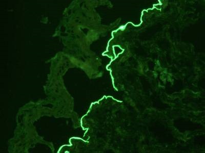  KSL Beutner Laboratories Launches First Blood Test  for Chronic, Debilitating Autoimmune Disease